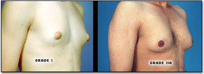 gynecomastia cyprus.png